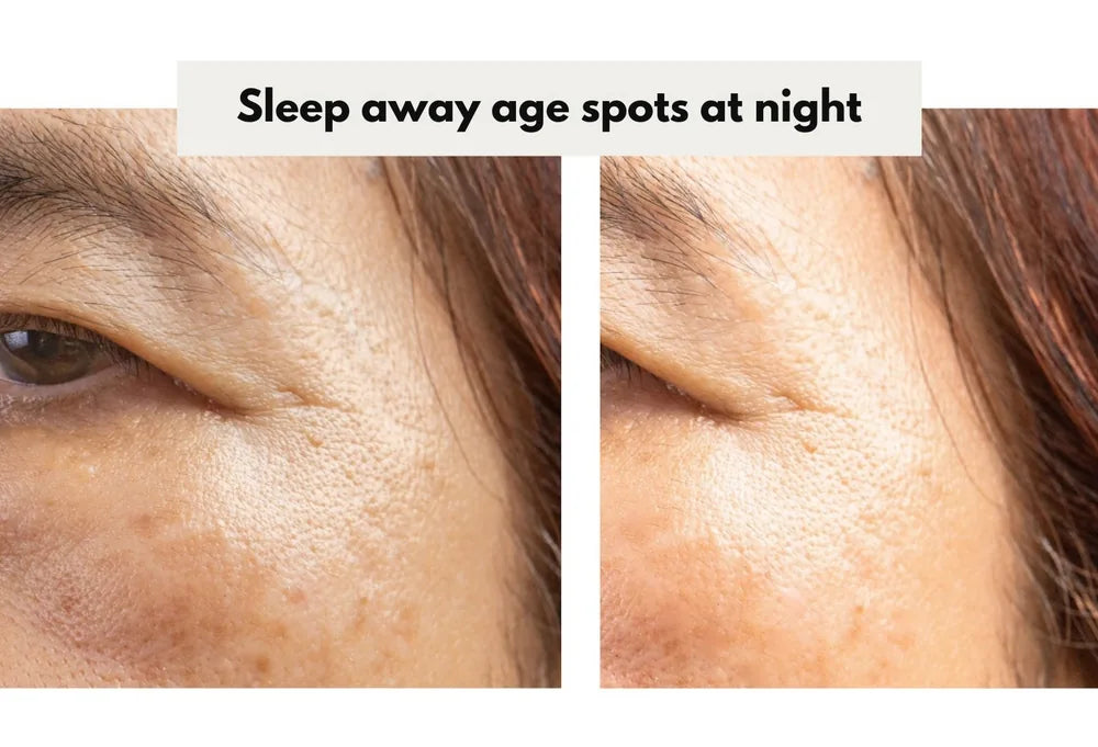 Age spots fading around the eye area overnight